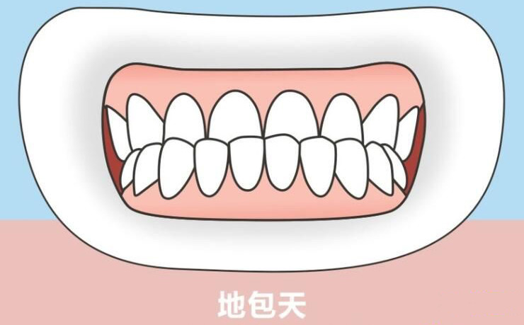 如果孩子有“地包天”，該怎么辦？